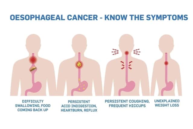 Initially, Jamie was in shock to receive the diagnosis. Although his grandmother had received the same diagnosis many years previous, oesophageal cancer had not been mentioned at any stage to Jamie. He was informed that he had an 8-10cm growth in his oesophagus.