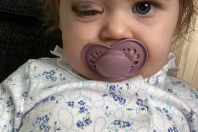 Toddler who lost her eye to rare cancer when she was one year old faces ...