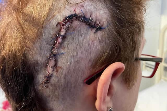 In 2013, Shirley said she went to the doctors after feeling very strange again. She discovered that her melanoma cancer had spread to her brain and she had a 5mm brain tumour on the left side of her brain.