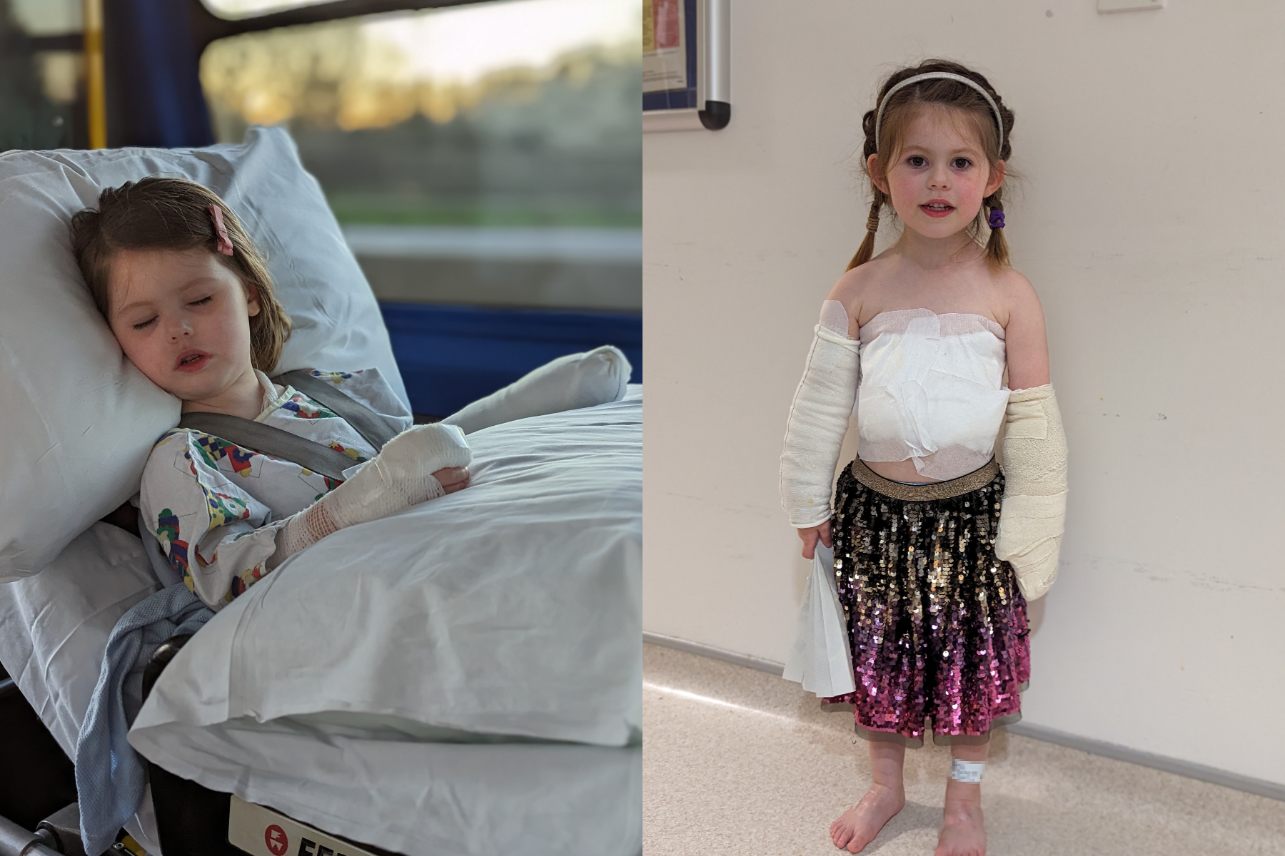 Girl, three, whose skin ‘fell off’ after accident with boiling water ...