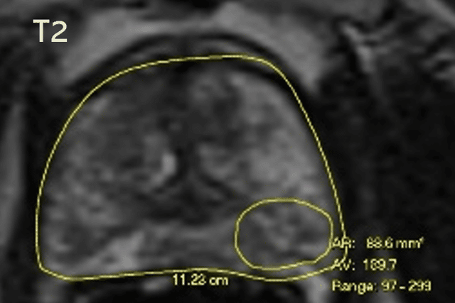 New prostate cancer imaging shows ‘extremely encouraging’ results in trials