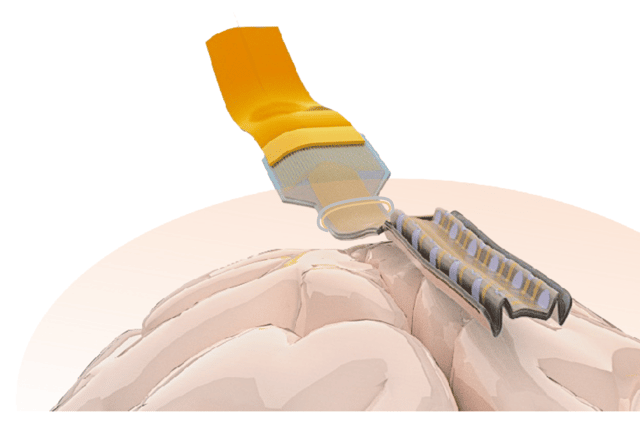 Damiano Barone, a neurosurgeon and clinical lecturer at the University of Cambridge, said the folding electrodes could potentially be used in combination with SEEG probes to improve epilepsy diagnosis.