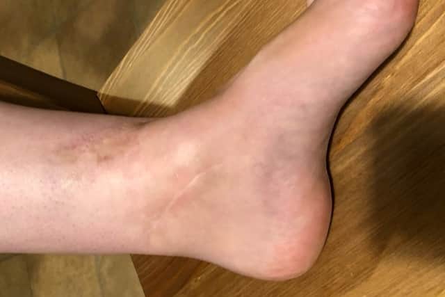 “In December 2019, I had another operation to remove some of the metal work in my foot,” she said.