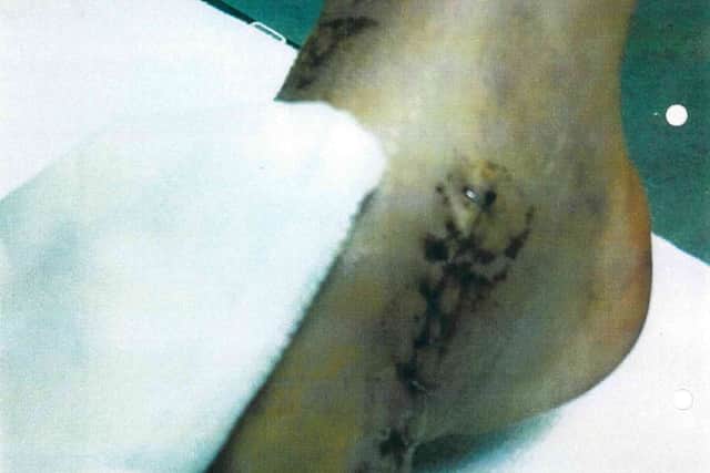 “I still have a lot of pain and it’s never going to go away.