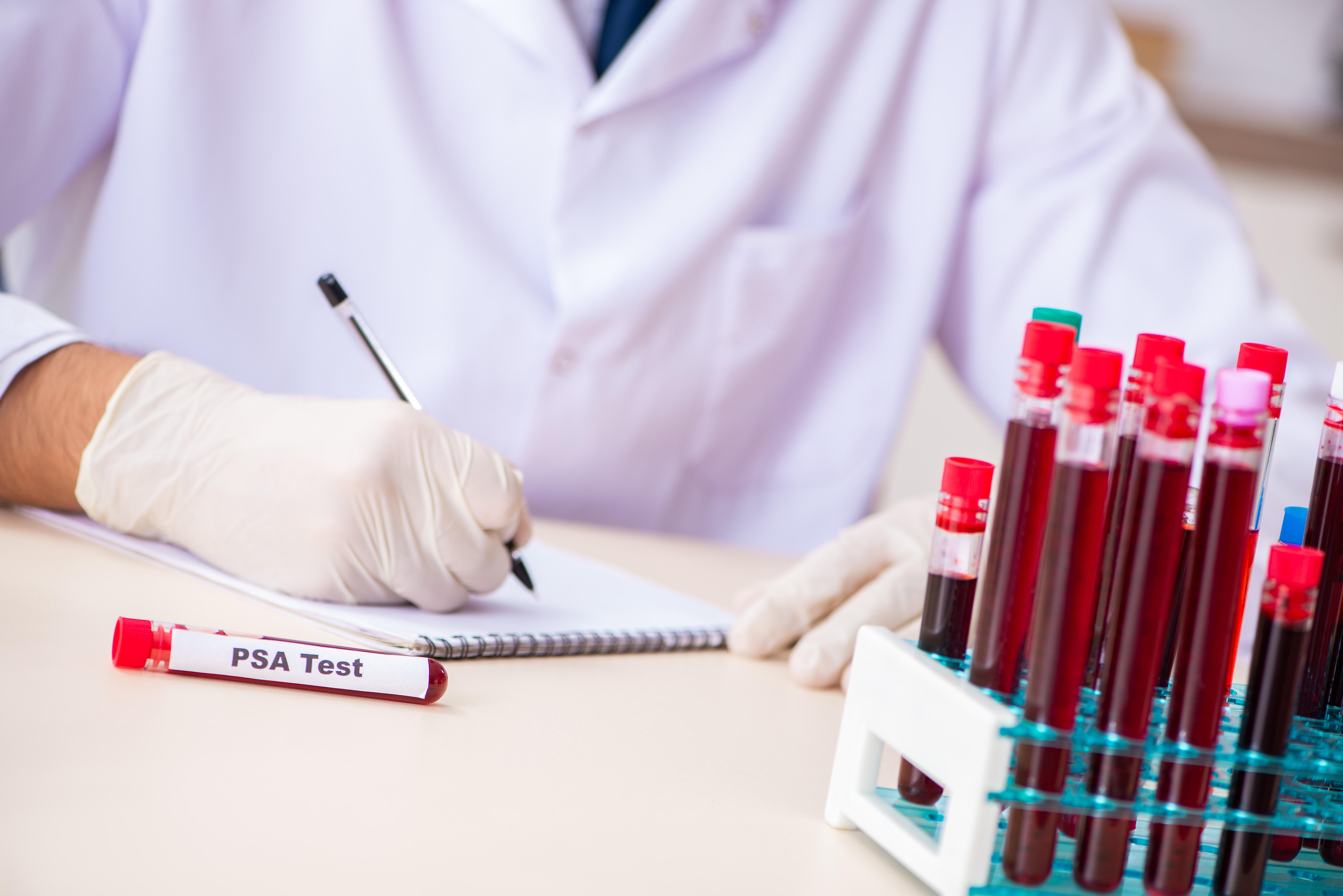 Prostate cancer test may lead to overdiagnosis in black men, study suggests