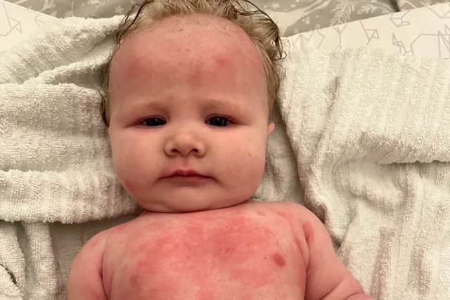 Mum whose baby suffered with eczema so bad it caused her to bleed found ...