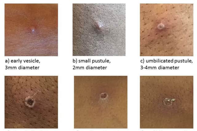 More than 300 monkeypox cases now recorded in the UK