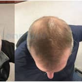 Millennium Hair Restoration Clinic - offering life changing, confidence building services with great success