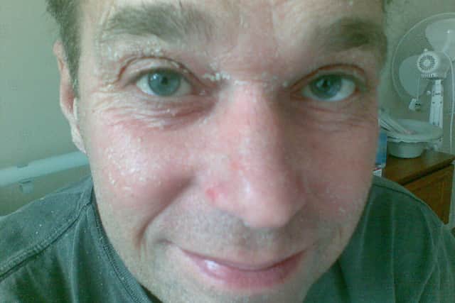 Quentin experienced flaky skin as a result of his treatment (Collect/PA Real Life)