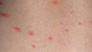 Public feedback invited on chicken pox vaccine in immunisation schedule