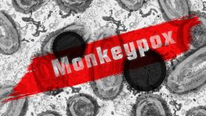 First cases of Monkeypox confirmed in Mid West