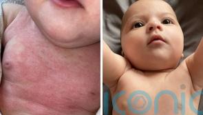 Adorable baby so coated in angry red eczema she wears socks on her hands to prevent scratching is “cured overnight” by £7.99 cream