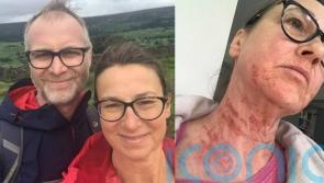 Teacher who used steroid creams for 44 years says her skin is “addicted” and vacuums her bed daily as she sheds it “like a snake” after quitting
