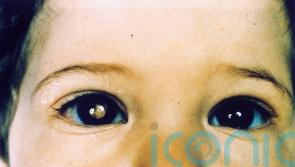 Test to spot rare eye cancer in unborn babies rolled out across NHS