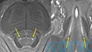 Powerful brain scanners offer hope for treating some Parkinson’s symptoms