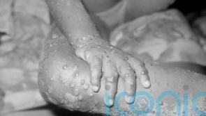 Monkeypox: 20 cases now confirmed in the UK