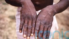 New monkeypox guidance tells high-risk close contacts to isolate for 21 days
