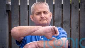 Man has double hand transplant in ‘world first’ for scleroderma patient