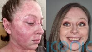 Call centre worker bedbound by eczema leaving her balding and sleeping in balaclava to stop her face sticking to sheet clears it with £9 cream