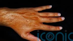 More UK cases identified in monkeypox outbreak