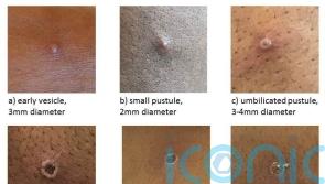 Monkeypox cases in Scotland increase to 18, figures show