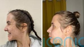 TikTok star looks like “cartoon character” as top jaw is 8mm too small until successful surgery which leaves her re-learning to “speak and kiss”