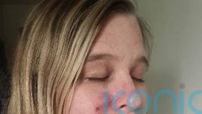 Mum felt “like a monster” and even hid her face from her daughter when she was struck with cystic acne after having Covid