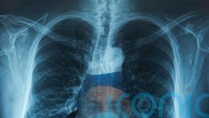 NHS campaign urges people not to ignore lung cancer symptoms