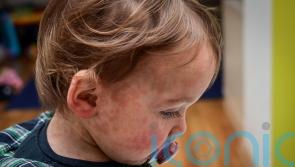 Audit finds variation in children’s allergy services across the UK