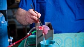 Transplant hope for minorities as researchers alter donor kidney blood type