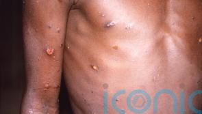 HSE widening rollout of monkeypox vaccine to people in Waterford at high risk