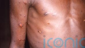 HSE widening rollout of monkeypox vaccine to people at high risk