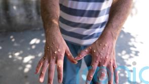 Advisory group on monkeypox will bring additional governance – CMO