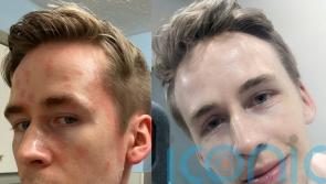 Man who “became a hermit” after waking to find himself covered in raindrop-size patches is “sassy” again thanks to a diet change and £19.99 cream