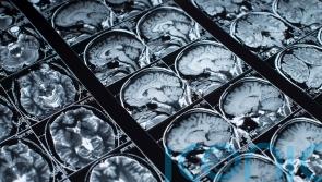 Some steroids ‘may change brain structure’ – study