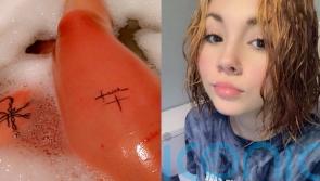Teenager with an ultra-rare allergy to water feels like she is being ‘set on fire’ when she showers and can’t cry because her tears give her hives