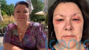 Woman who became a recluse after menopause-triggered eczema made her ‘look like a vampire’ praises ‘miracle’ cream cure