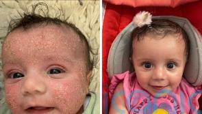Adorable tot who wore mittens to stop her scratching her painful eczema now has ‘baby soft skin’ thanks to a £7.99 cream