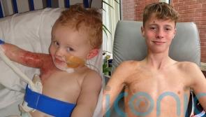 Mum feared her baby’s life was ruined after a boiling pan fell on him – now they’ve written an inspiring book together