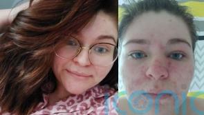 Mum-of-two who became a recluse due to pregnancy-induced acne now feels ‘free’ thanks to ‘life-changing’ cure