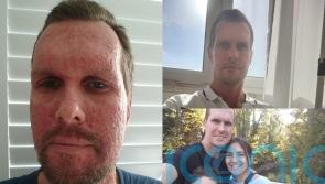 Dad with cancer who looked like the ‘Nightmare on Elm Street’ after chemo now hopes German vaccine can save his life