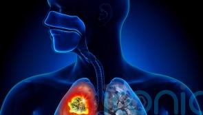 Lung Cancer Awareness Month: Myths about lung cancer everyone needs to stop believing