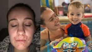 Mum who was too embarrassed to take her son swimming due to acne celebrates her clear skin with a trip to the pool