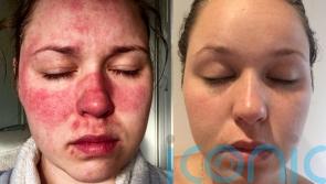 A mum-to-be who found it hard to put her face on her pillow due to red sore patches has regained her confidence