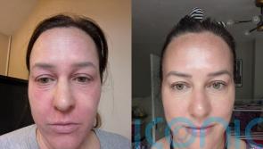 Mum whose eczema felt like ‘torture’ and made her ‘hate herself’ has since healed her skin and is enjoying life again