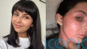 Woman who spent last Christmas with skin condition too painful to sleep now feeling festive after ‘unbelievable’ fix