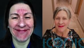 Former Met police officer who suffered stress-triggered skin condition after workplace bullying finds ‘miracle’ cure