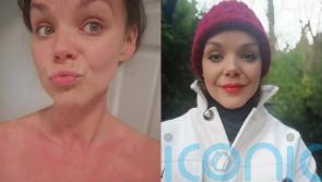 Carer allergic to cold told she looks like a &lsquo;monster&rsquo; due to skin&rsquo;s red and blotchy reaction to low temperatures