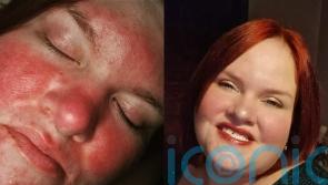 Woman with rosacea who was branded ‘a tomato’ and endured cosmetic surgery jokes from her ex has found a miracle cure