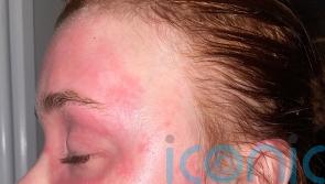 Woman whose face swelled due to topical steroid withdrawal says condition was so painful she could barely open her eyes